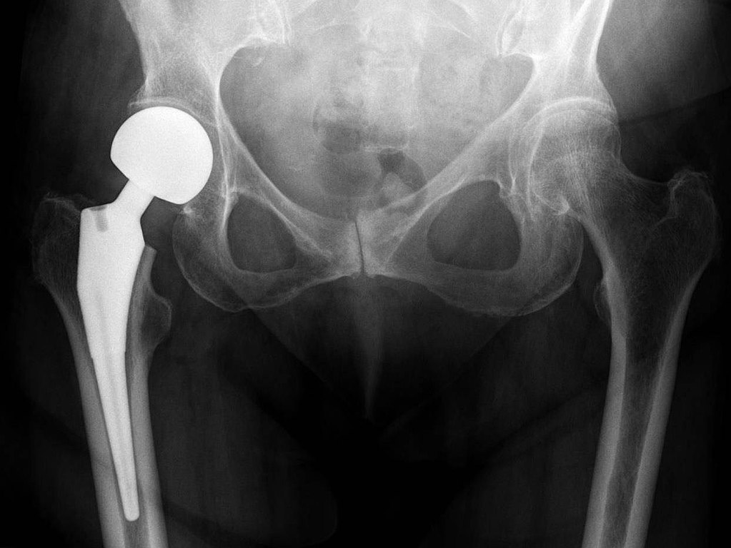 IJA_web's tweet photo. How does PENG block compare with Fascia Iliaca block for analgesia post total hip arthroplasty?
Read this systematic review in Nov '23 issue of #IJA https://t.co/q62nDRDd1u
#hipreplacement #pengblock #fasciailiaca @ASRA_Society @ESRA_Society @RegionalAnaesUK @AoraIndia https://t.co/bcIb2pmezy