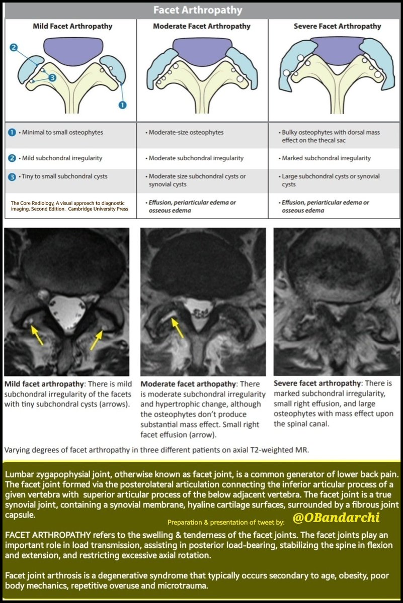 Facet joints are the only synovial joints in the spine & can be involved in a large number of pathological processe . F J Arthritis could be due to aging,repetitive stress on the joints, poor posture,obesity,... FJs help in load transmission, flexion& extensionin of spine,..etc