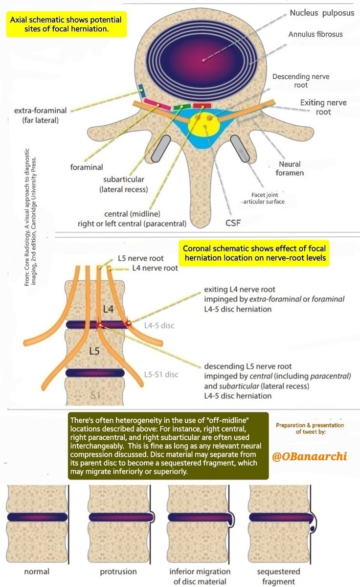 Axial illustration:potential sites of focal herniation. Coronal illustration:effect of focal herniation LOCATION on nerve-root level. Focal herniation Location: -Central(midline) -R or L Central(Paracentral) -Subarticular(Lateral recess) -Foraminal -Extraforaminal(Far lateral)