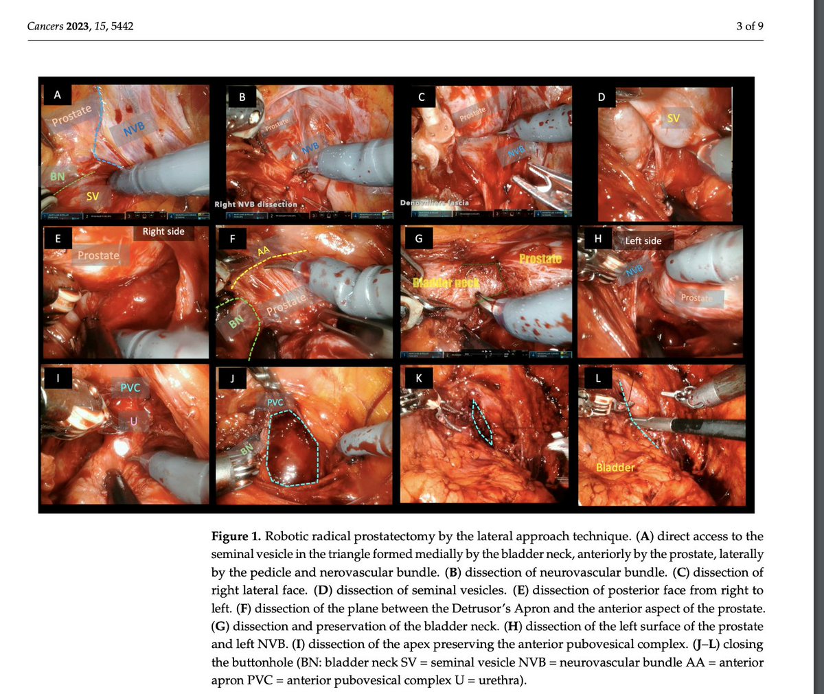 Robot-Assisted Radical Prostatectomy by Lateral Approach: Technique, Reproducibility and Outcomes avalaible at: mdpi.com/2072-6694/15/2… Thanks to all the @ICUAurologia team