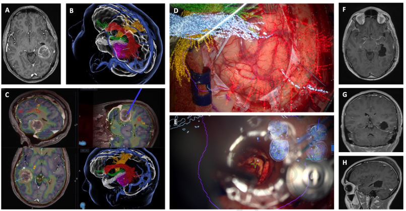 We have now published our experience and literature review on 'Impact of Preoperative Mapping and Intraoperative Neuromonitoring in Minimal Invasive Parafascicular Surgery for Deep-seated Lesions' <a href="/WorldNeurosurg/">World Neurosurgery Journal</a>.

doi.org/10.1016/j.wneu…
<a href="/Sidsinha92/">Siddharth Sinha</a> <a href="/lavrador_jose/">José Pedro Lavrador</a> <a href="/Sabzp87/">Sabina</a>