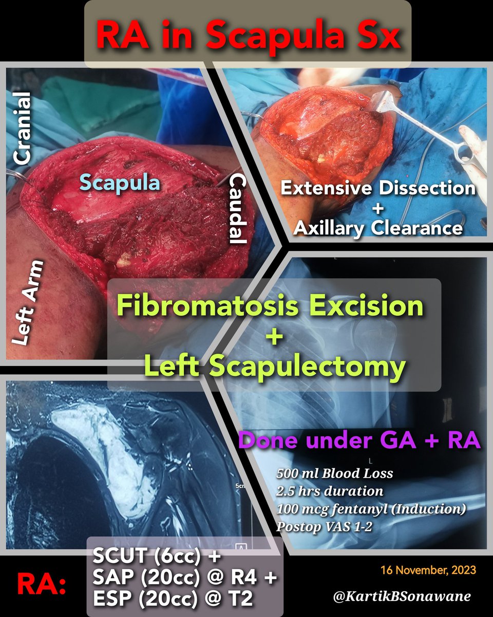 KartikBSonawane's tweet photo. "RA in Scapula Sx"

#RAinScapulaSurgery
#ScapularBlock
#Scapulaanalgesia
#Painmanagementinscapulasurgery

My 10 points:

1. Scapula is complexly innervated Structure. "Identify-Select-Combine" Approach helps to plan RA technique for any such complexly innervated structures.

2. Most of its innervations are  derived from C5 & C6 roots. However, all innervations are derived from cervical and brachial plexus EXCEPT skin of back region.

3. Skin over scapula is supplied by Dorsal Rami (T2-T9/10). For this ESP with Diluted LA will be sufficient.

4. Muscles attached to the scapula are innervated by Brachial Plexus.

5. Understanding Steps of Sx, Positioning of Patient, Duration of Surgery, Incisions,& Innervations of involved structure is essential to plan Suitable RA technique.

6. Planned procedure-Specific RA technique should cover innervation of incisional area (Dermatome) & involved scapula bone (Osteotome).

7. Myotomal coverage needed only for the muscles which are involved in surgical dissection.

8. Myotomal coverage for muscle relaxation is needed only if Surgery will be under Sole RA. For that high conc. LA can be used.

9. For analgesia purpose, Myotomal coverage is not needed. So diluted LA can be used (Motor-Sparing block).

10. Depending upon the surgical plan and extending dissections, Combinations of blocks are required for Scapula surgery. For that knowledge of Spared innervations of primary blocks and knowledge of Supplementary blocks to cover those are essential.

In our Case, We gave Combination of 

SCUT (SupraClavicular + UT) block to involve C5 & C6 + SCN (to cover skin over & above spine of scapula).

SAP to cover Axillary dissection (T2-T9) with LTN & TDN.

ESP to cover skin over the Scapula.