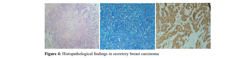 AnnalsMedical's tweet photo. #Secretory Breast Carcinoma - Case Report https://t.co/2baiFKFk2N