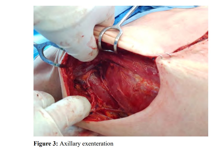 AnnalsMedical's tweet photo. #Secretory Breast Carcinoma - Case Report https://t.co/2baiFKFk2N