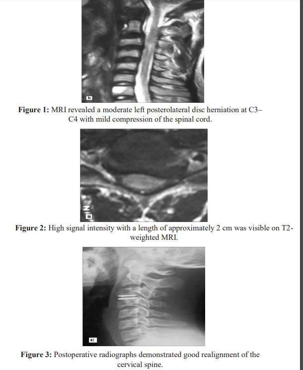 AnnalsMedical's tweet image. #Contralateral Extremity Paresis and Numbness Caused by Pos-tero lateral Disc Herniation at C3–C4 in a Teenager is very interesting paper you can visit it by using this below link:
acmcasereport.org/wp-content/upl…
