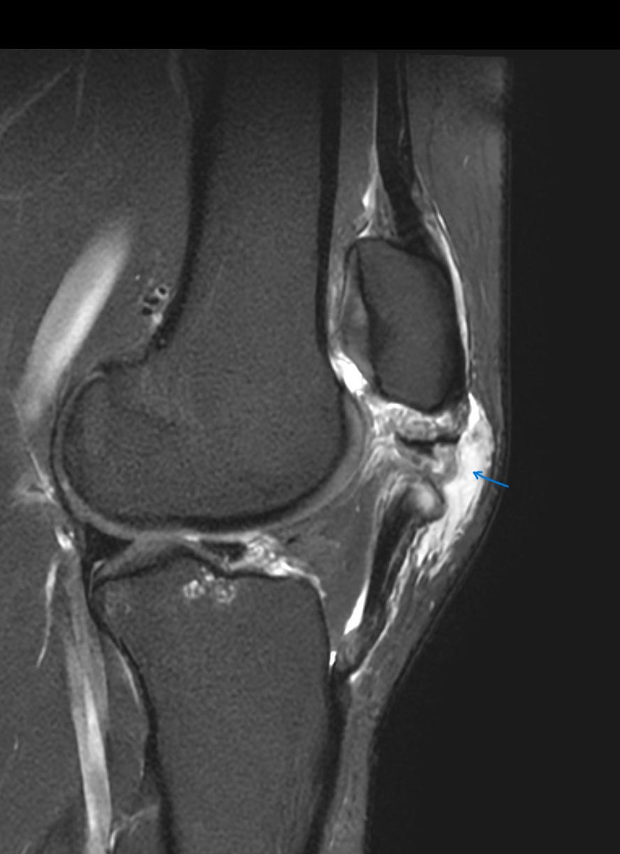 Patellar tendon rupture #EMrad #MSKrad #MedStudentTwitter #radres #EmergencyMedicine #orthotwitter