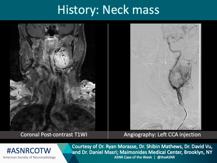 ASNR COTW #173

Hx: Neck mass 

NO SPOILERS!!! Give hints in the form of GIF or answer attached poll.  Answer in 24 hrs      

#Neuro #Neurorad #Erad #radres #FOAMed #FOAMrad #medtwitter #ASNRCOTW