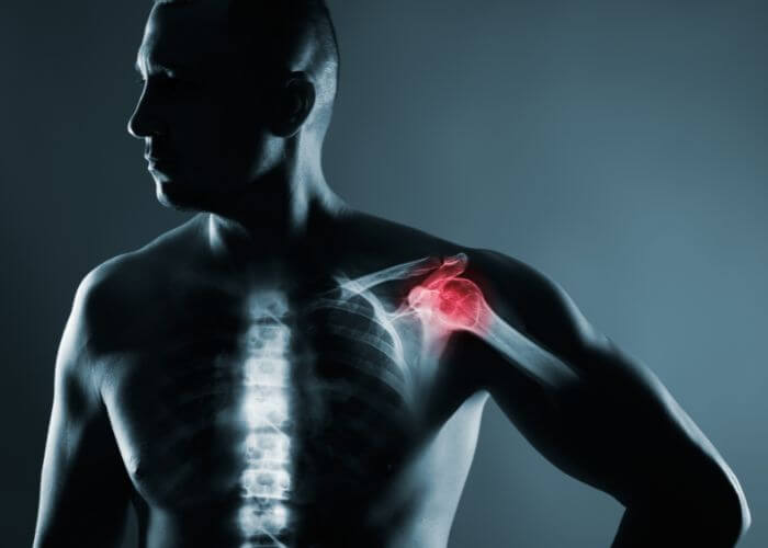 What is #suprascapular nerve decompression? Here is a breakdown of what you need to know: medilink.us/tbp7 #sholderpain #shouldertreamtent #orthotwitter