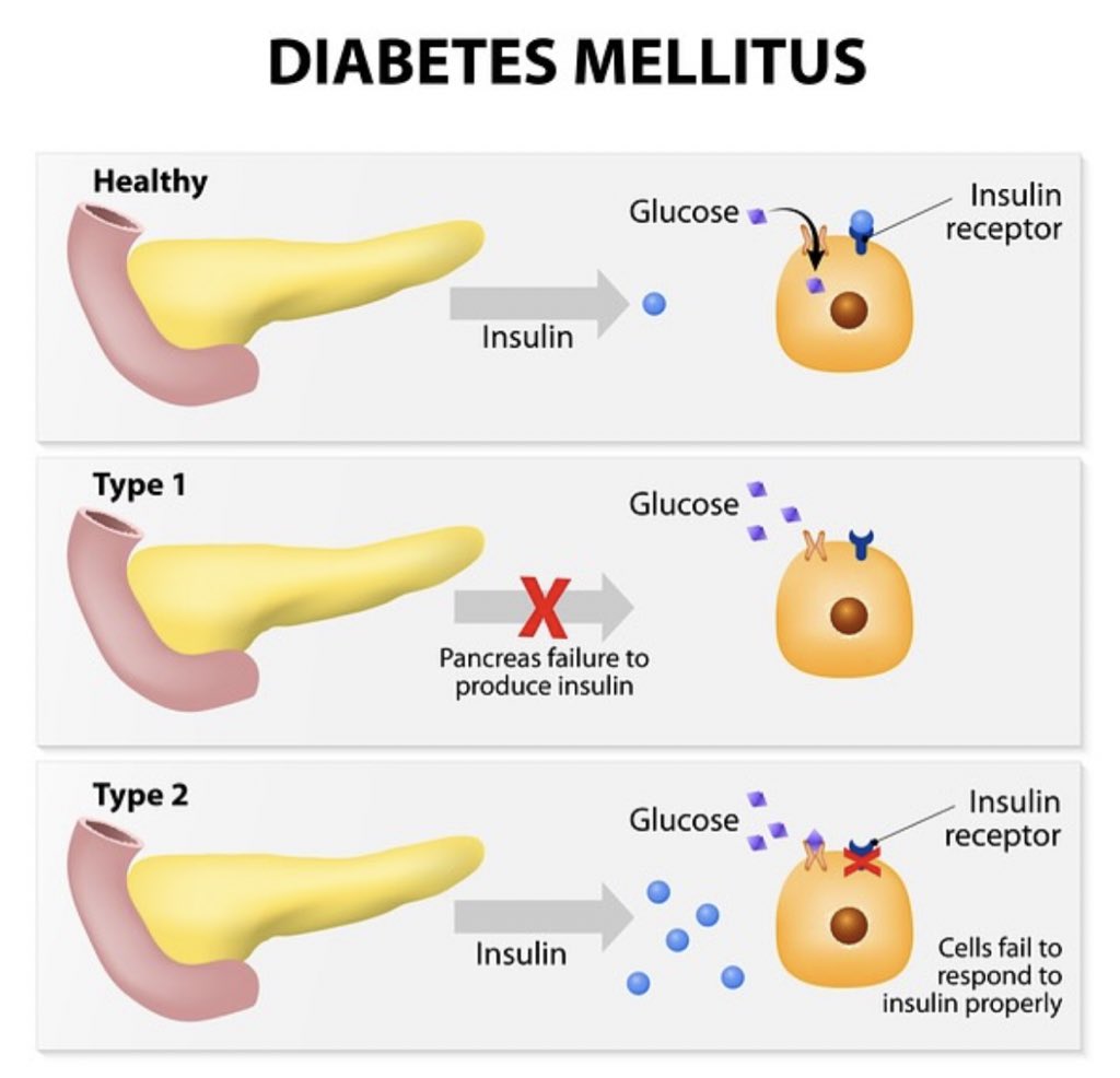انواع مرض السكر 🩸🔬
