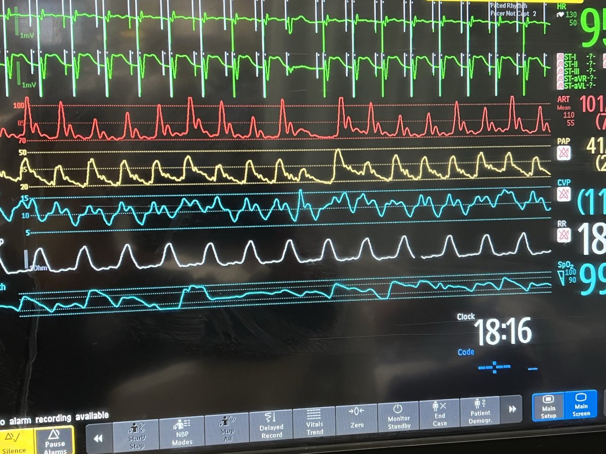 They say a picture 📸 is worth a thousand words 🫀Post-op patient for CABG/AVR 🫀BP 102/75 (75) 🫀PA 42/20 (28) 🫀Lactate 5–>8–>10 What’s going on? @PittCCM @PittCardiology @UPMC_CTSurgery @EMinMiami @PACCM_fellows @PittIMChiefs #CardioTwitter #MedEd #MedTwitter