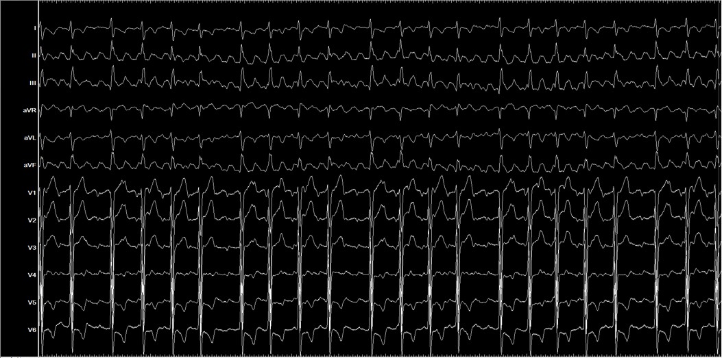 Eduardo Franco Díez (@edufrancodiez) on Twitter photo 1/10. Atypical atrial flutter in a re-do procedure (prior PVI + roof line + anteroseptal mitral line) performed with #EnsiteX. <a href="/Arritmias_HRC/">Arritmias H. Ramón y Cajal, Madrid.</a> <a href="/cris_lozano/">Cristina Lozano</a> #EPeeps 1/10. Atypical atrial flutter in a re-do procedure (prior PVI + roof line + anteroseptal mitral line) performed with #EnsiteX. <a href="/Arritmias_HRC/">Arritmias H. Ramón y Cajal, Madrid.</a> <a href="/cris_lozano/">Cristina Lozano</a> #EPeeps