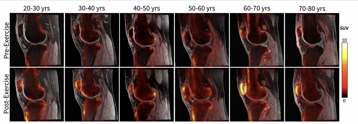 Thank you Ananya Goyal (Ph.D. Student in BioE) for presenting at the RSL: We are evaluating whether [18F] NaF PET-MRI around a loading stress-test can identify changes in joint function associated with age.