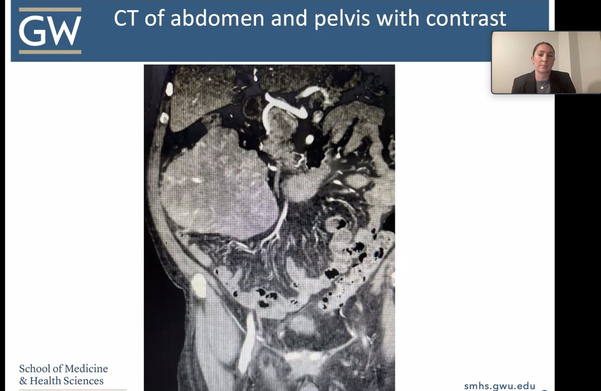 MetroDCACS (@metrodcacs) on Twitter photo #DCACS All City Grand Rounds third case presentation by MS2 Christina Schott from <a href="/GWSMHS/">GW SMHS</a> <a href="/GWSurgery/">GW Surgery</a> presenting on A Rare Presentation of Meckel’s Diverticulum 👏
<a href="/AmCollSurgeons/">American College of Surgeons</a> <a href="/AmColSurgCancer/">ACS Cancer Programs</a> #DCACS All City Grand Rounds third case presentation by MS2 Christina Schott from <a href="/GWSMHS/">GW SMHS</a> <a href="/GWSurgery/">GW Surgery</a> presenting on A Rare Presentation of Meckel’s Diverticulum 👏
<a href="/AmCollSurgeons/">American College of Surgeons</a> <a href="/AmColSurgCancer/">ACS Cancer Programs</a>