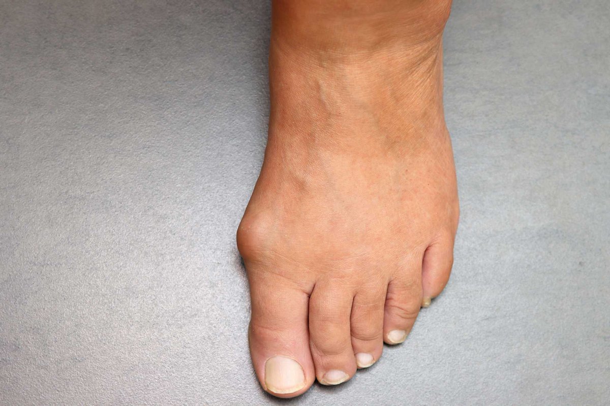 BurlingtonFoot's tweet photo. Don't let bunions keep you from your favorite activities. Our team can evaluate your situation and recommend the best steps for relief. #StayActive #BunionSolution
https://t.co/qg8vVuBkOB https://t.co/3S82CIowkE