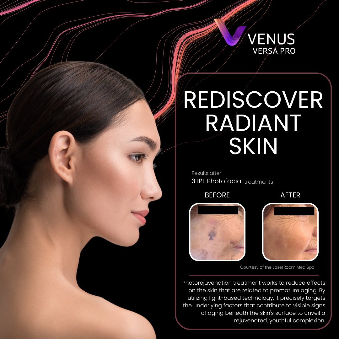 Venus Versa™ Pro's Intense Pulsed Light (IPL) Photofacial is the perfect treatment to get rid of sun damage and premature signs of aging in a fast, safe, and effective way. IPL technology can lighten age spots and improve skin tone and texture.  bit.ly/PhotofacialTre…