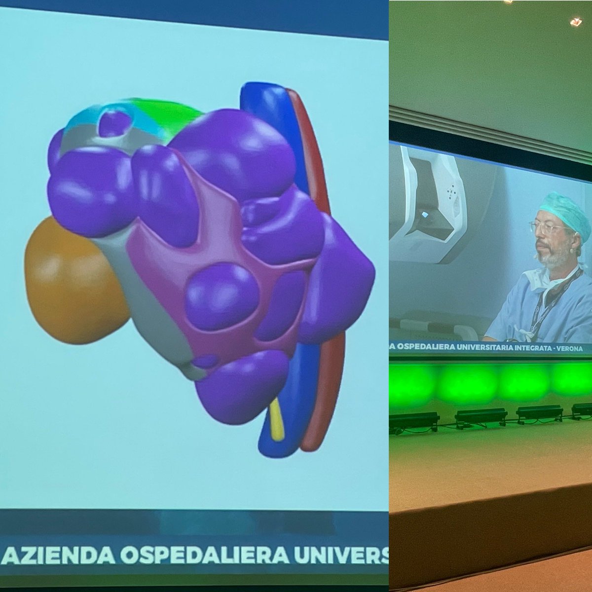 RicBertolo's tweet photo. Packed room in the afternoon of the #Masterclass on #RAPN: different #approaches and #resection #techniques with Prof. @aleantonellibs1 performing #retroperitoneal #enucleoresection and Prof. @minerviniandre performing #transperitoneal #enucleation https://t.co/gJz3aIpuLy
