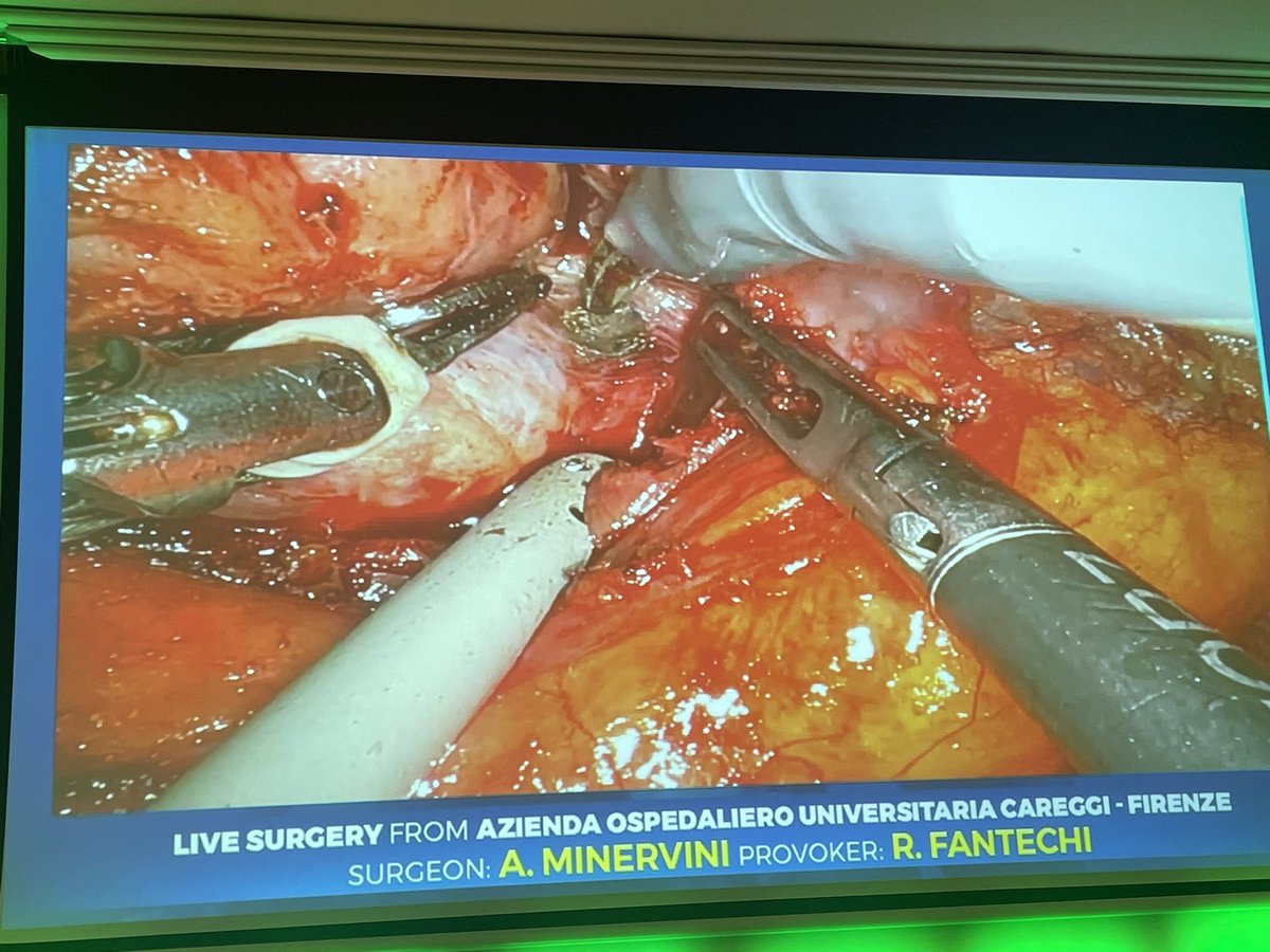 RicBertolo's tweet photo. Packed room in the afternoon of the #Masterclass on #RAPN: different #approaches and #resection #techniques with Prof. @aleantonellibs1 performing #retroperitoneal #enucleoresection and Prof. @minerviniandre performing #transperitoneal #enucleation https://t.co/gJz3aIpuLy