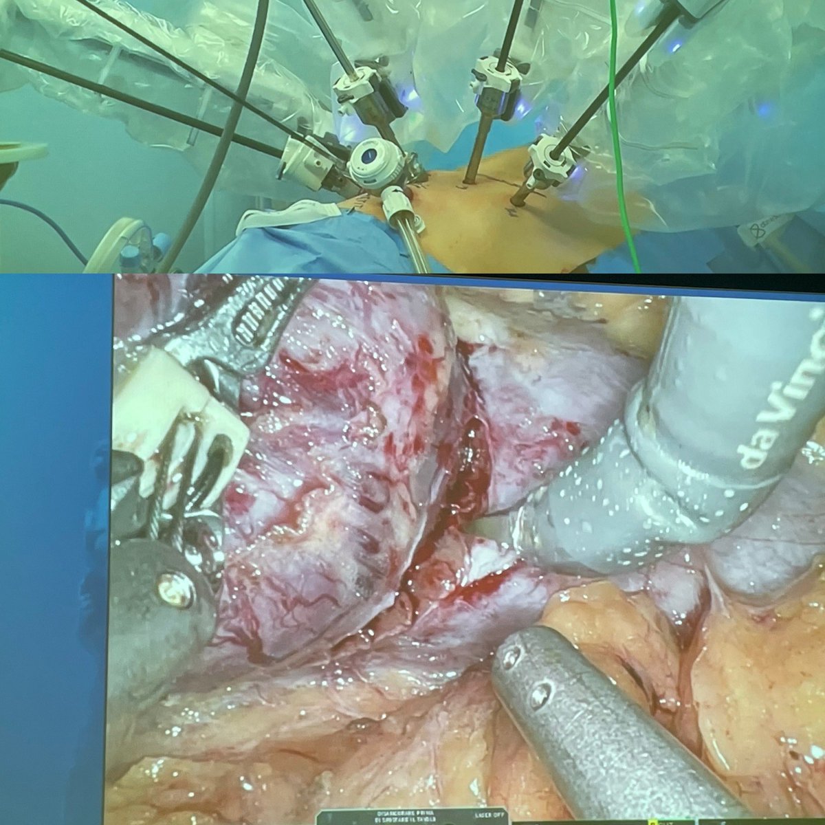 RicBertolo's tweet photo. Packed room in the afternoon of the #Masterclass on #RAPN: different #approaches and #resection #techniques with Prof. @aleantonellibs1 performing #retroperitoneal #enucleoresection and Prof. @minerviniandre performing #transperitoneal #enucleation https://t.co/gJz3aIpuLy