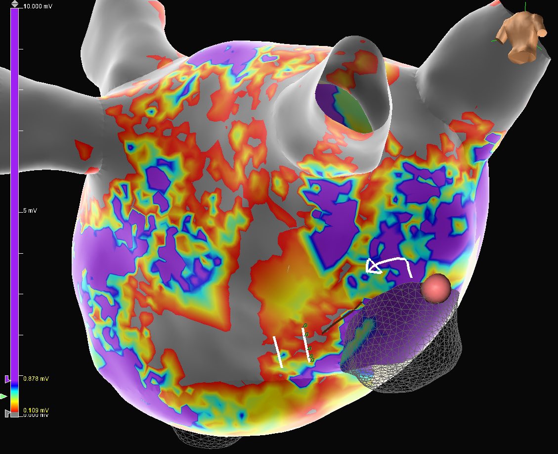 theRhythmDocs's tweet photo. Interesting septostomy LAFL circuit in a redo AF patient. AFL cycling around a small line of block near prior transeptal scar. Long fractionated EGMs seen with #HDGrid and #OTNearField - terminated here in 2s of RF. 

EP: Dr. Sameer Satija
Mapping: @MitriJessica https://t.co/kFPAn5l9lQ