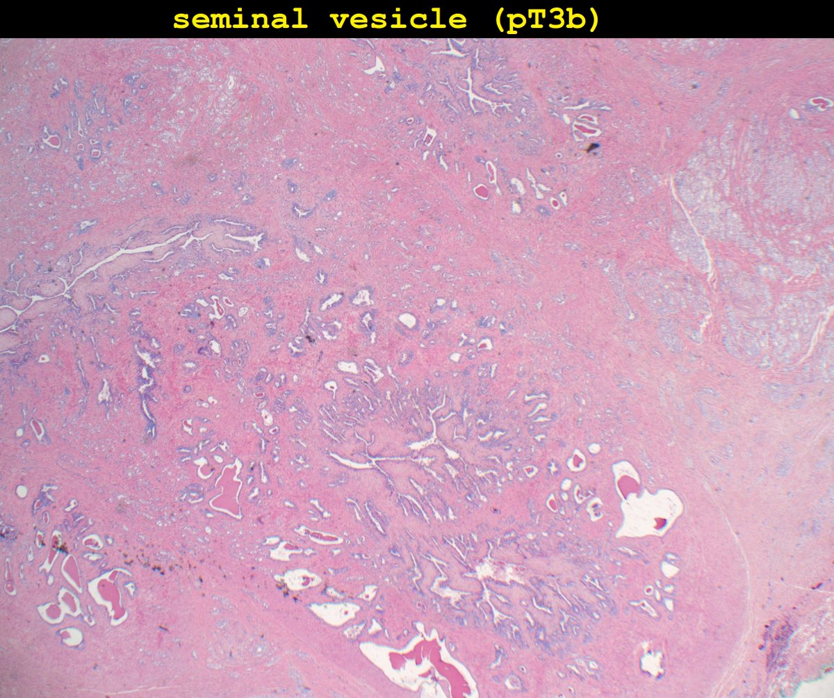 slusagar's tweet photo. Remember that ejac duct is INTRAprostatic➡️despite similar🔬histology to seminal vesicle, invasive tumor around ejac duct is NOT pT3b
#GUpath #prostatepath https://t.co/a48t76nU5x