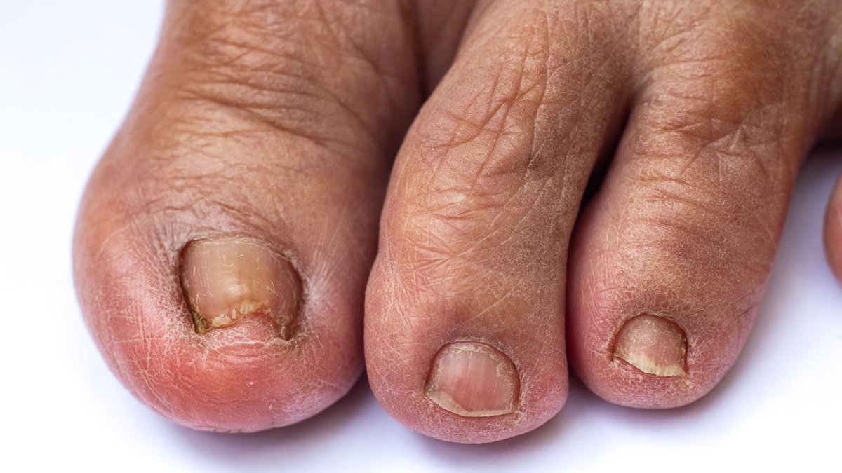 🤔 Wondering why your toenails are causing you pain? Learn about the causes of ingrown toenails and how to prevent them. Say goodbye to discomfort! #PainfulNails #ToenailHealth
bit.ly/3ONJX5Y
