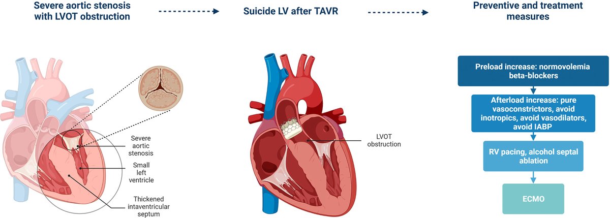 JACC Journals (@jaccjournals) on Twitter photo The clinical phenomenon of “suicide left ventricle” after #TAVR is associated with worse clinical outcomes and may be anticipated and successfully prevented with the implementation of simple measures. bit.ly/47n9YSg
#JACCCaseReports #CardioTwitter <a href="/LKoliastasis/">Leonidas Koliastasis</a> The clinical phenomenon of “suicide left ventricle” after #TAVR is associated with worse clinical outcomes and may be anticipated and successfully prevented with the implementation of simple measures. bit.ly/47n9YSg
#JACCCaseReports #CardioTwitter <a href="/LKoliastasis/">Leonidas Koliastasis</a>