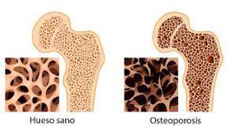 PulsoRed's tweet photo. Recomienda IMSS Tlaxcala alternativas para prevenir o minimizar la osteoporosis https://t.co/nZhWmCxlfm vía @PulsoRed https://t.co/8AAd0G7UyF