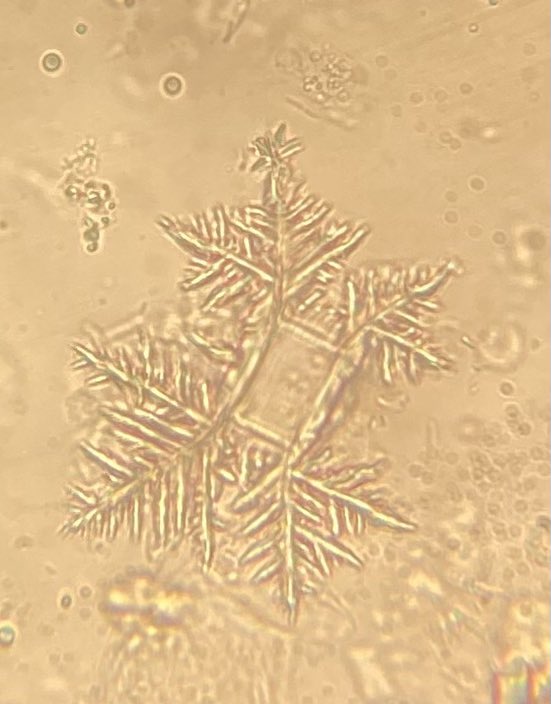 The winter came early🙃❄️ #UrineMicroscopy #Struvite #UrineCrystals