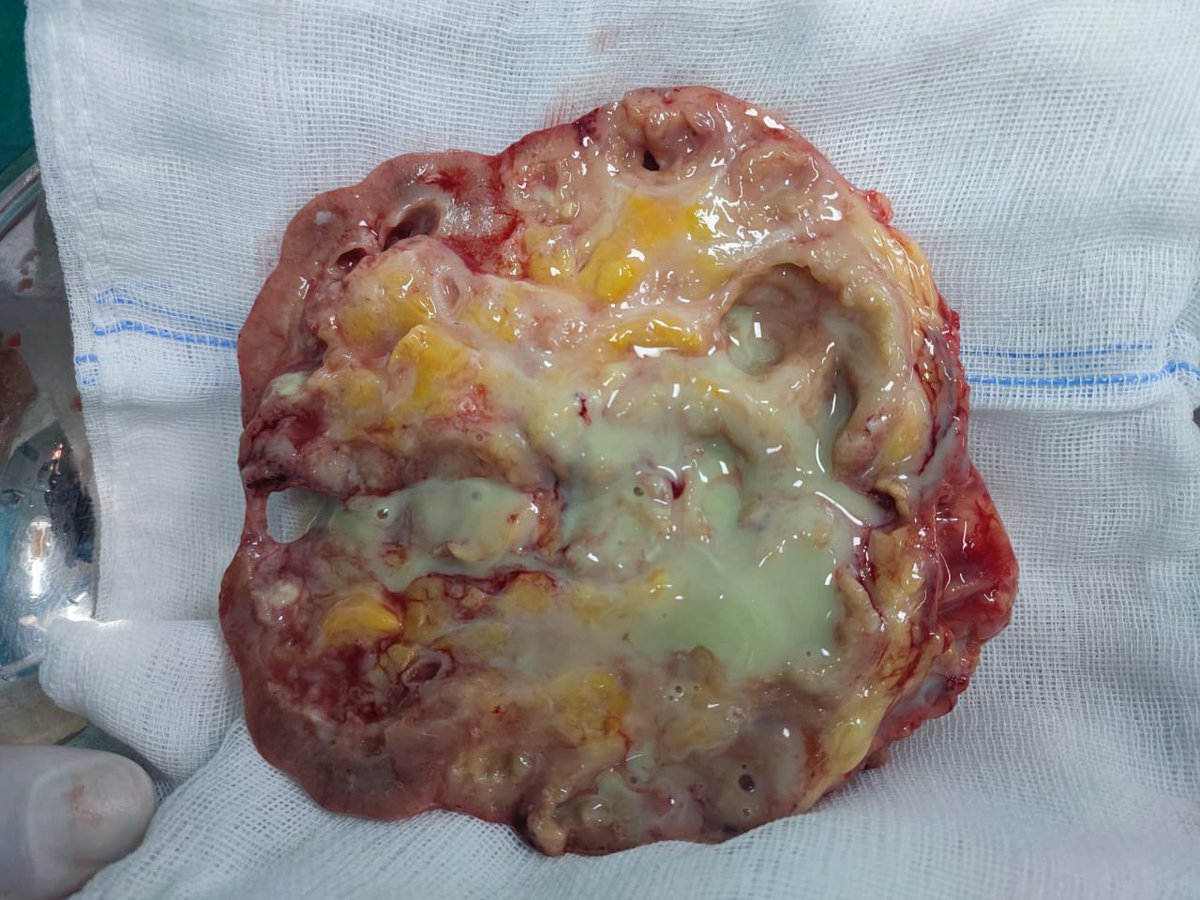 UroSurSCZ's tweet photo. @uroServera @HManacor Muy frecuente en nuestro medio, En pacientes DBT mal controlados y TBC. https://t.co/damfYFDEX2