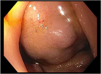 Fangyuan Jin-Dominguez et al showcase "A case of duodenal variceal bleeding treated by Doppler-guided endoscopic cyanoacrylate injection" in this Original Article. videogie.org/article/S2468-…

<a href="/KaraRaphael/">Kara Raphael</a>