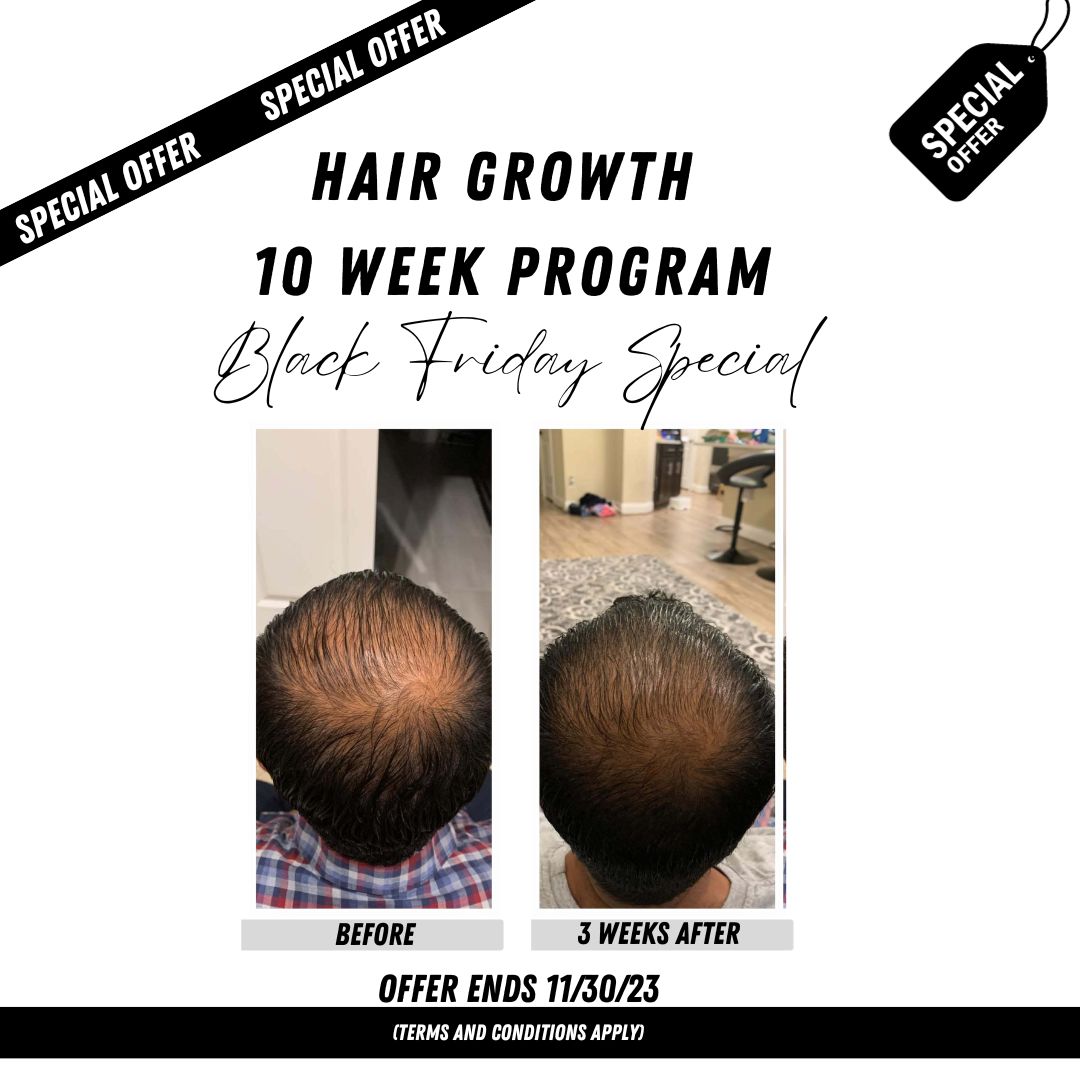 LipoSculp's tweet photo. ✨LipoSculp Hair Growth 10 Week Program! Black Friday Special Offer!✨ Call us at 888-854-7672 or book online to get started today! (offer ends 11/30/23) #liposculpvegas #hairgrowth #blackfriday #specialoffer #fallspecials #selfcareseason #lasvegasbeauty #vegasspa #menshealth https://t.co/tfOWE3It8l