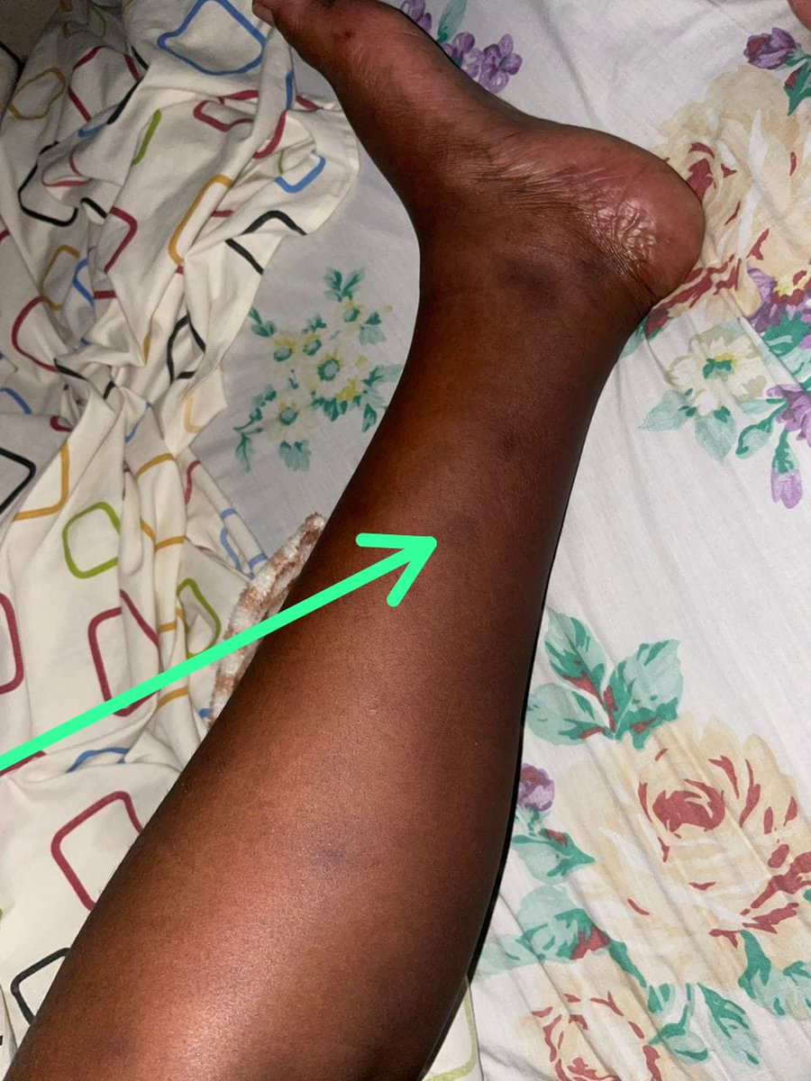 kuyisingiza's tweet photo. @BrownJHM 31 yrs A female patient has a discoloured skin on the body,  accompany with a body mass , itching when it comes and after filling pain on both legs ,it happened 15yrs ago ( 2008).what is diagnosis and treatment? https://t.co/QALmuHMkEB