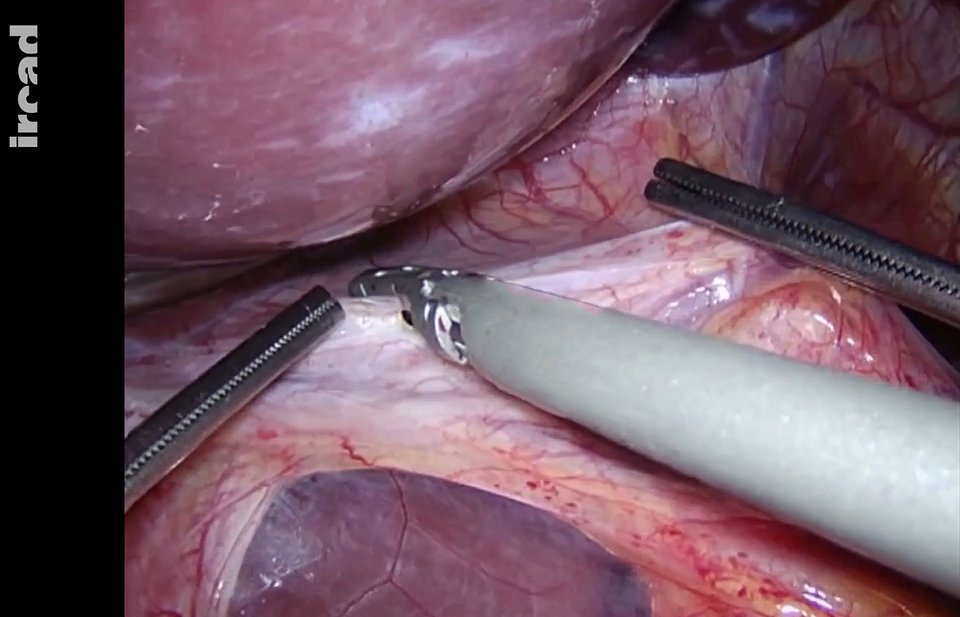 websurg's tweet photo. 🚨NEW VIDEO ALERT:
🔗 https://t.co/yUMAre28ue
“Laparoscopic Heller's cardiomyotomy and Dor fundoplication, a stepwise approach to achalasia”

#websurg #ircad #surgery #minimallyinvasivesurgery #uppergisurgery https://t.co/ecTIRvGX5r