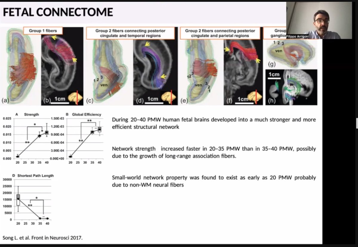 spinacademics's tweet image. Commencing Part 2 of the SPIN 2023 Course&apos;s Fetal Session with an enlightening presentation by Dr. Fillipo Arrigoni on axonal pathfinding disorders! Setting the bar high for an insightful and engaging session ahead. #SPIN2023 #Neuroradiology