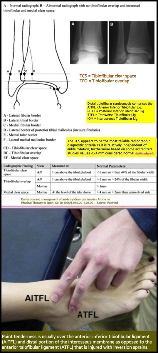 Distal tibiofibular syndesmosis comprises the AITFL, PITFL, TTFL, IOM. TCS=TFCS is the most reliable radiographic criteria to help Dx of syndesmosis injury(it's independent of ankle rotation). TFO is not reliable criteria,as some people may not having it,as normal variation).