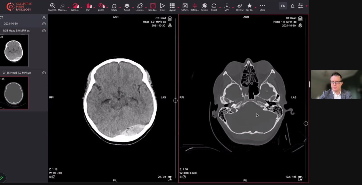Lalani Carlton Jones (@neuroradlal) on Twitter photo And we are off! 2nd on call day starting a jam packed day of all things acute neuroradiology <a href="/theBSNR/">BSNR</a> fantastic talks already from the brilliant <a href="/skafiabadi/">Sina Kafiabadi</a> <a href="/RekhaSiripurapu/">Rekha Siripurapu</a> 👏🏾👏🏾 #neurorad <a href="/BSNRTrainees/">BSNR Trainees</a> And we are off! 2nd on call day starting a jam packed day of all things acute neuroradiology <a href="/theBSNR/">BSNR</a> fantastic talks already from the brilliant <a href="/skafiabadi/">Sina Kafiabadi</a> <a href="/RekhaSiripurapu/">Rekha Siripurapu</a> 👏🏾👏🏾 #neurorad <a href="/BSNRTrainees/">BSNR Trainees</a>