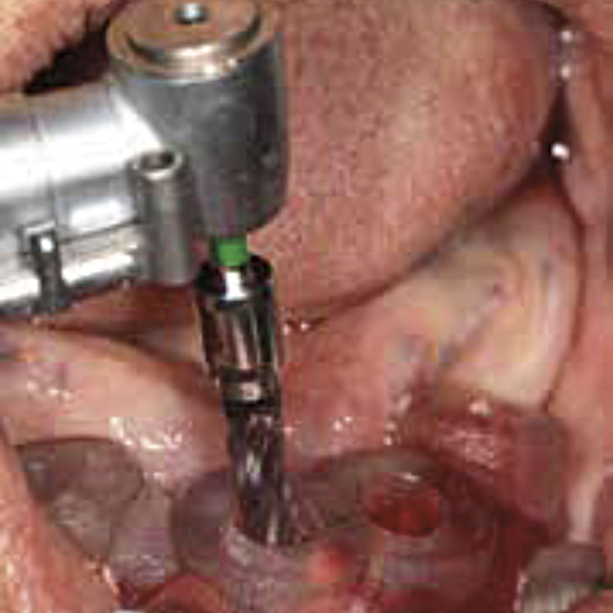 Implant Practice US - Dental Continuing Education tweet media