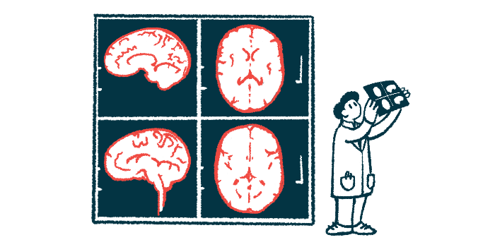 DrLNotes's tweet photo. Man has unusual case of sarcoidosis affecting brain, many organs https://t.co/KuVwyOMpIe 

#sarcoidosis #headache #neurosarcoidosis #DrLNotes https://t.co/wS1exdBsBe