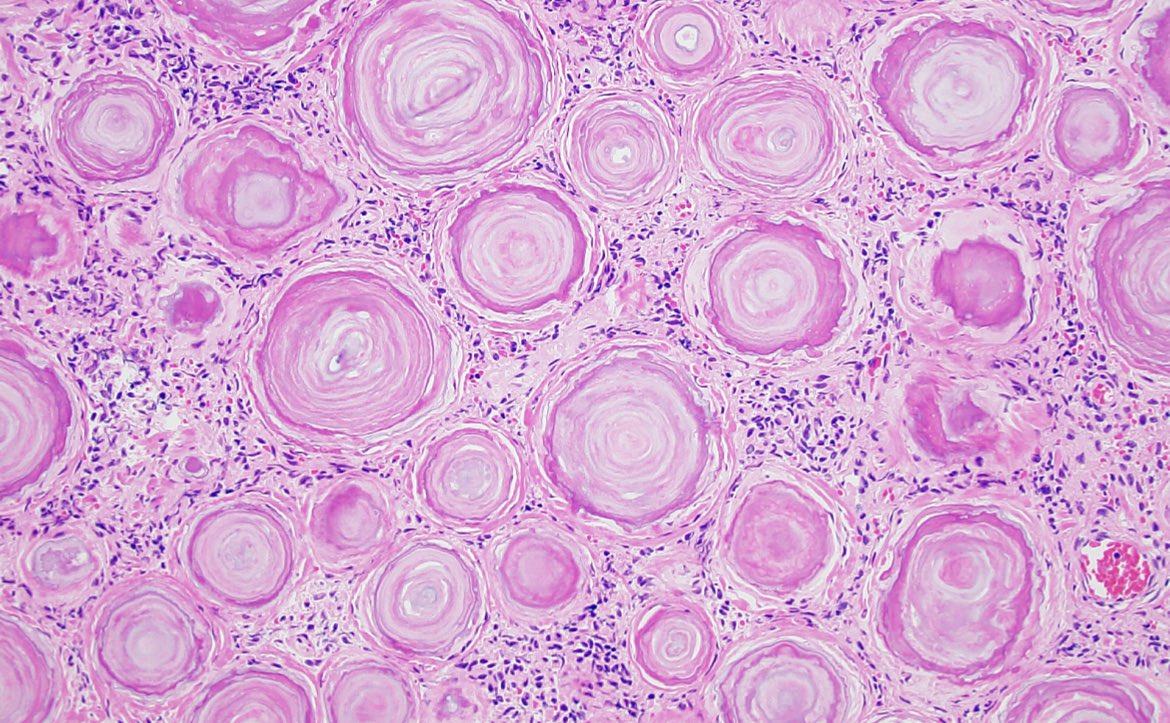 Psammomatous #meningioma is one of my favorite things to see under the #microscope. Always gives me a groovy, psychedelic vibe. #neuropath #PathArt 🧠🔬
