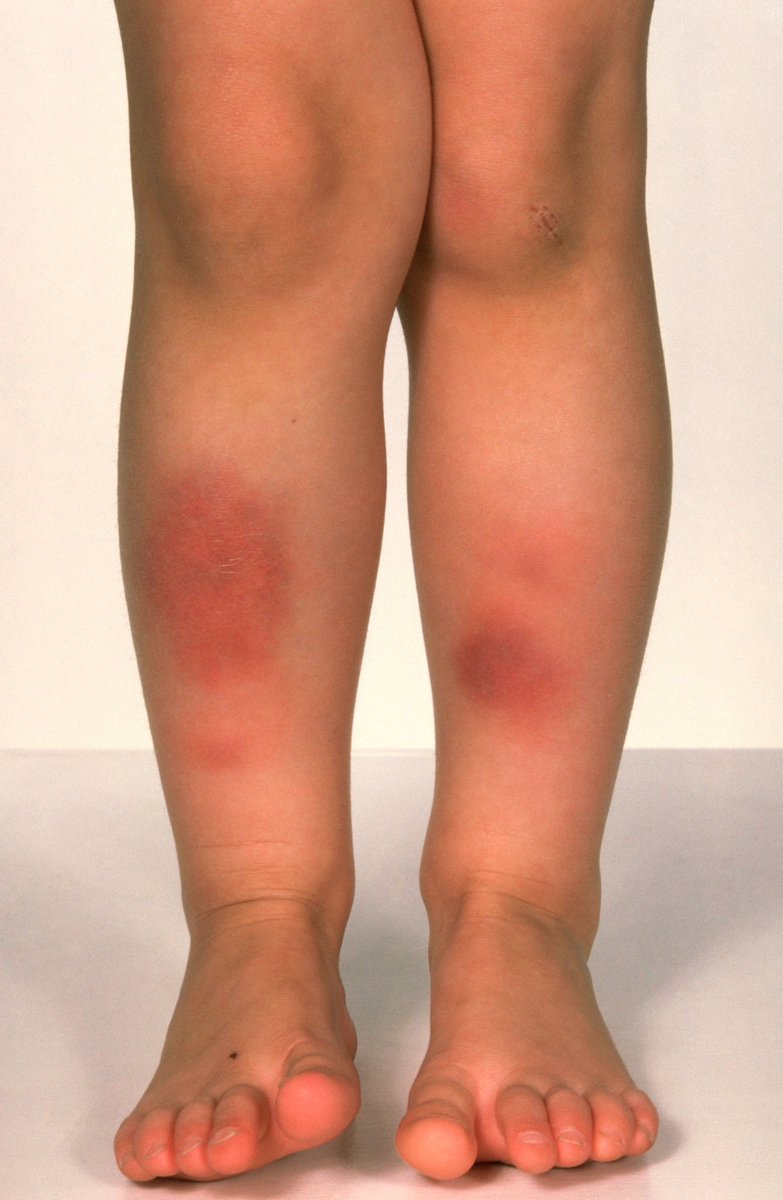 lets_diagnose's tweet photo. Spot diagnosis?

••Painful tender nodules on patients shins••

A) erythema multiforme
B) erythema nodosum
C) erythema migrans
D) erythema marginatum https://t.co/9zjPRYHrHC