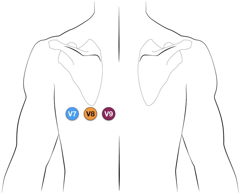 md1talk's tweet photo. دخلتم على مريض ولقيتم ال leads حقت ال ECG مركبة ورا تحت الكتف الايسر 

تتوقعون ملخبطين ولا عندهم شيء يبون يشوفونه  ؟ https://t.co/eUcjAUNPdO