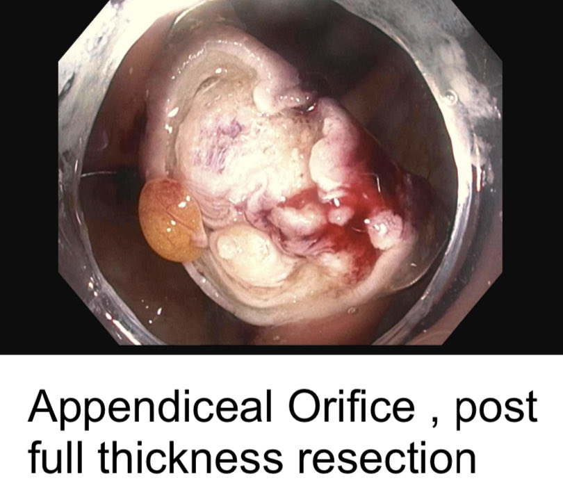 EUSandEndoscopy's tweet photo. Mark, grasp, pull up, deploy #OVESCO EFTRD clip, snare excise & retrieve to perform endoscopic full thickness resection #EFTR of adenoma extending down into #appendiceal orifice @OvescoEndoscopy https://t.co/G0Hkr7nbW7