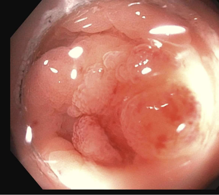 EUSandEndoscopy's tweet photo. Mark, grasp, pull up, deploy #OVESCO EFTRD clip, snare excise & retrieve to perform endoscopic full thickness resection #EFTR of adenoma extending down into #appendiceal orifice @OvescoEndoscopy https://t.co/G0Hkr7nbW7