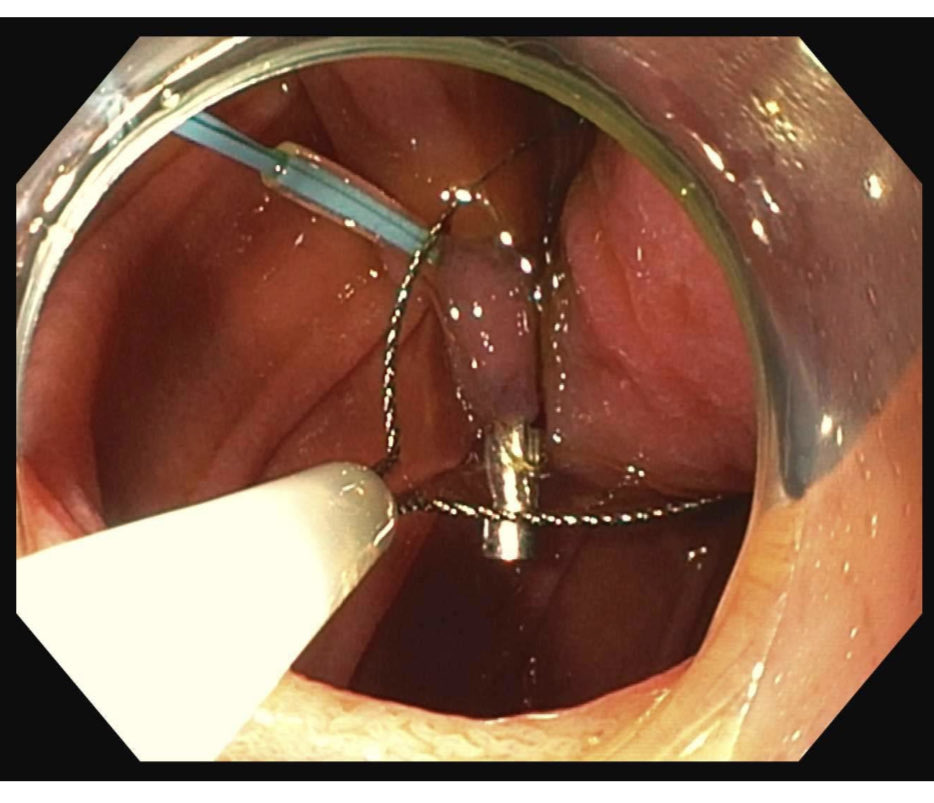 EUSandEndoscopy's tweet photo. Very large pedunculated #Lipoma on a long stalk proximal duodenum found by #foregut surgeon during endoscopy at time HH repair & Linx referred for endoscopic resection, removed by cautery snare #endoloop + #endoscopicclip of stalk https://t.co/0qKjnDa2sX