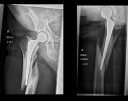 🔎CASE IN FOCUS! 🩻 How would you treat this fracture in a fit and active 73-year-old male patient five years after a well-functioning primary THA? a) Revision - cement in cement b) Revision - uncemented fluted taper c) Fixation - PPF locking plate d) Fixation - DCP #THA #BJJ