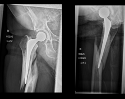 Radiograph of a periprosthetic hip fracture.