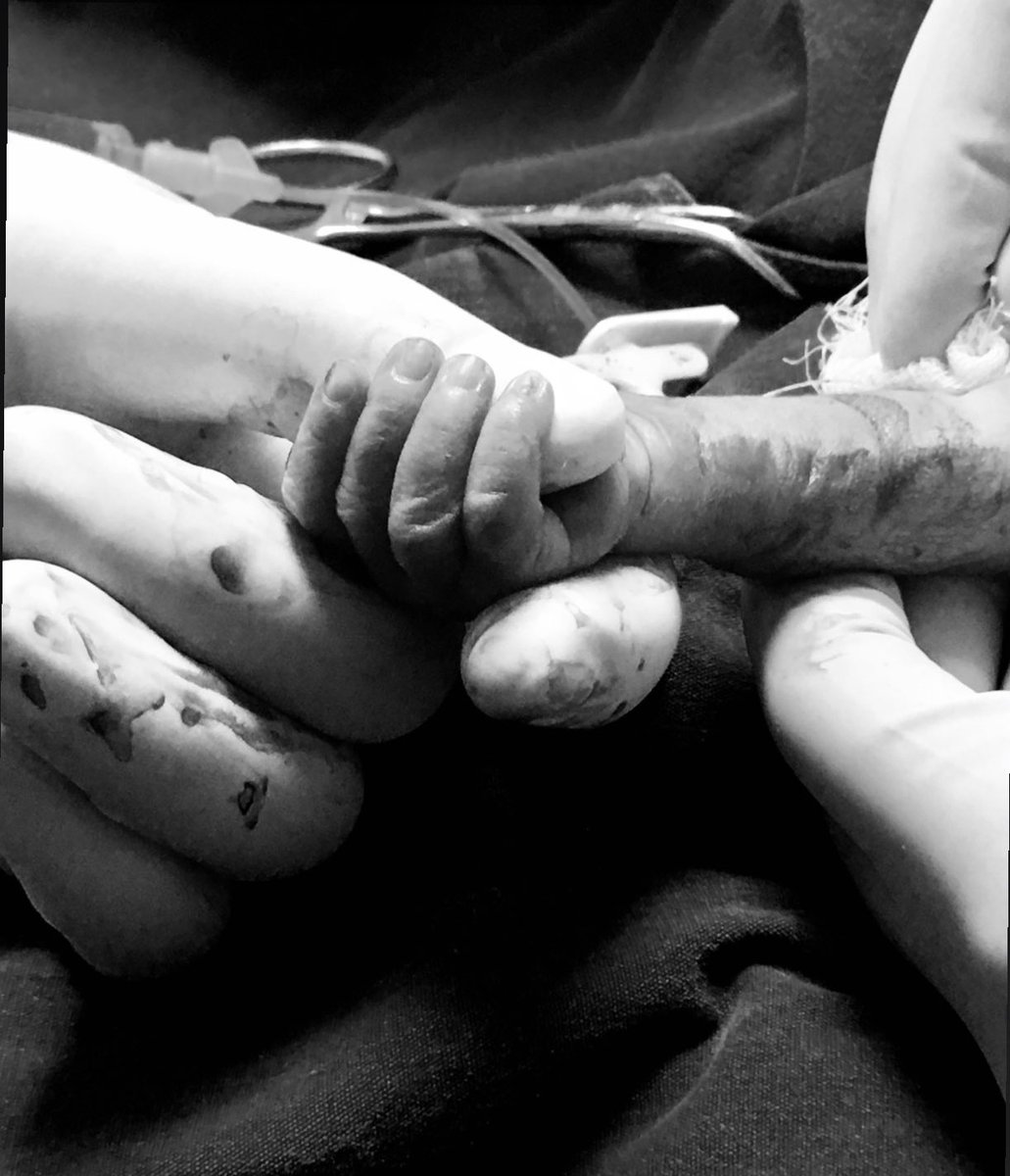 belonimo's tweet photo. 17 Kasım Dünya Prematüre Günü kutlu olsun. 💜
Fotoğrafta elimi tutan bu minik arkadaşım doğduğunda henüz 900 gr idi.
Çocuk doktoru olarak yaşayabileceğiniz en büyülü anlardan biridir bu, minicik bir kalbin hayata tutunmasına yardım ettiğiniz o an… https://t.co/pyNDDBFvyT