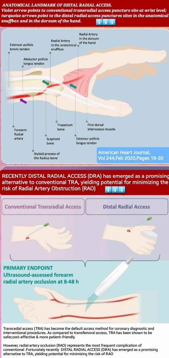 Transradial access (TRA) has become the default access method for coronary interventions & compared to transfemoral,is safer. doi.org/10.1016/j.ahj.… The complication of TRA is : Radial artery occlusion (RAO).But DISTAL RADIAL ACCESS (DRA) has solved the problem & is promising...