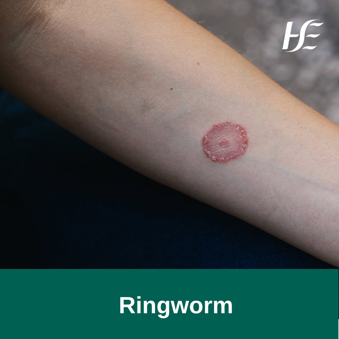 Tinea Corporis or Ring Worm is a Treatable Fungal Infection