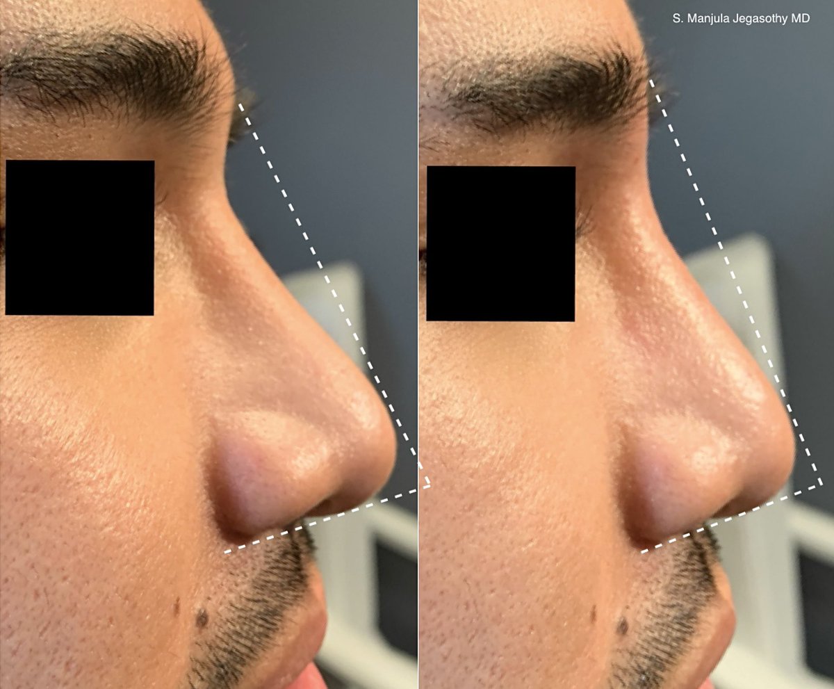Elevate your profile with a #NonSurgical #FillerNoseJob 💉👃🏼 (also known as a #LiquidRhinoplasty) by Miami’s renowned injector, #DrJegasothy 👩🏽‍⚕️🏆!

#Filler can be used on the #NasalBridge to #StraightenTheNose 📏, add volume & definition, camouflage a #DorsalHump , lift the